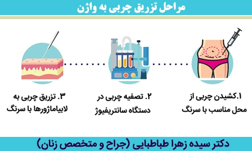 مراحل-تزریق-چربی-به-واژن