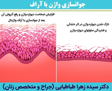 جوانسازی-واژن-با-آراف