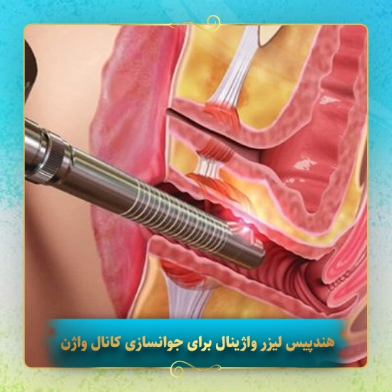 هندپیس-لیزر-واژینال-برای-جوانسازی-کانال-واژن