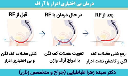 درمان-بی-اختیاری-ادرار-با-آر-اف