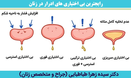 رایجترین-بی-اختیاری-های-ادرار-در-زنان_
