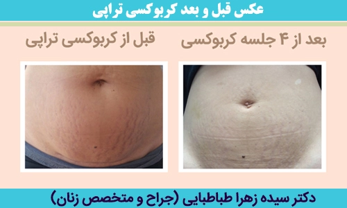عکس-قبل-و-بعد-کربوکسی-تراپی
