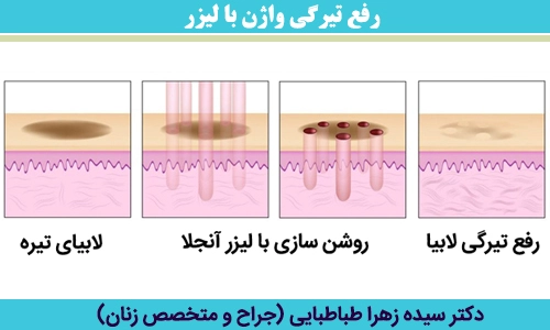 رفع-تیرگی-واژن-با-لیزر