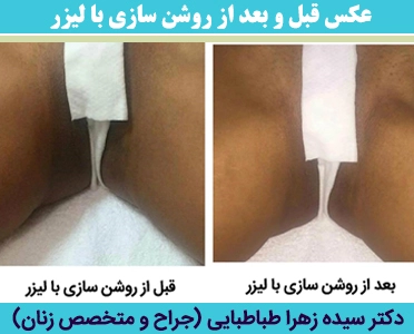 عکس-قبل-و-بعد-از-روشن-سازی-با-لیزر