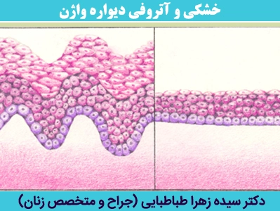خشکی-و-آتروفی-دیواره-واژن