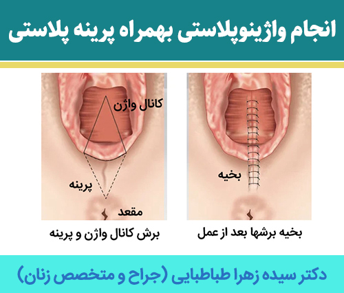 انجام-واژینوپلاستی-بهمراه-پرینه-پلاستی