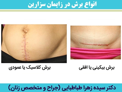 انواع-برش-در-زایمان-سزارین