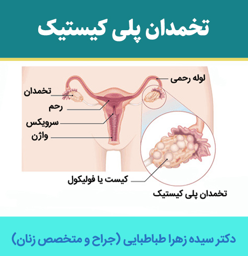 تخمدان-پلی-کیستیک