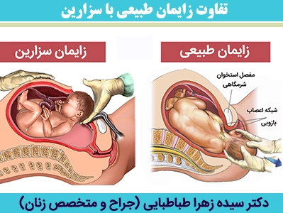 تفاوت-زایمان-طبیعی-با-سزارین