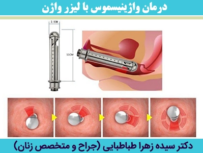 درمان-واژینیسموس-با-لیزر-واژن