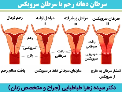 سرطان-دهانه-رحم-یا-سرطان-سرویکس