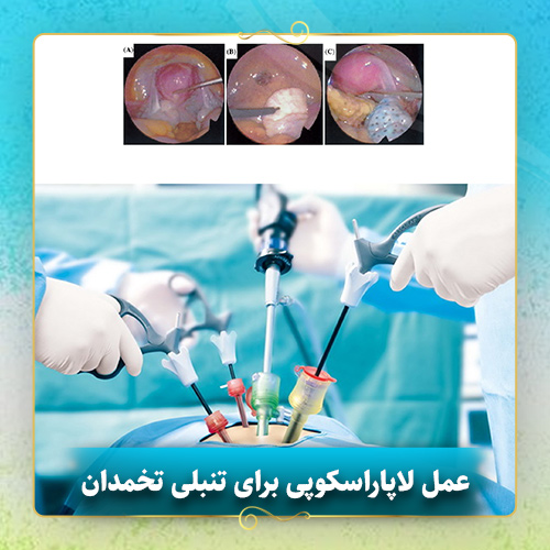 عمل-لاپاراسکوپی-برای-تنبلی-تخمدان