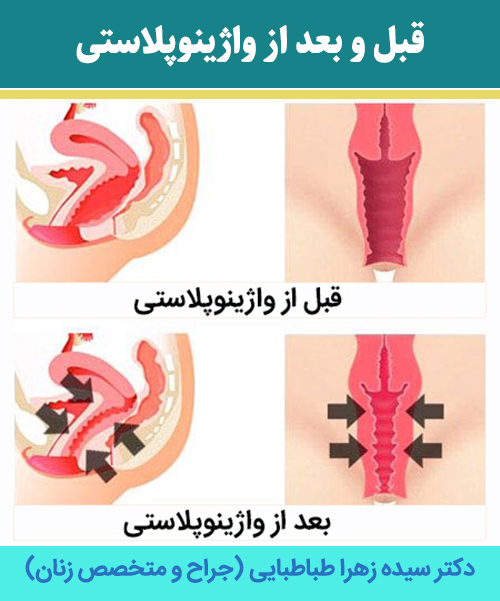 قبل-و-بعد-از-واژینوپلاستی