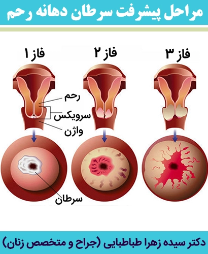مراحل-پیشرفت-سرطان-دهانه-رحم