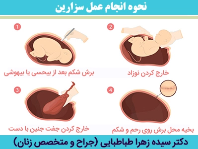 نحوه-انجام-عمل-سزارین