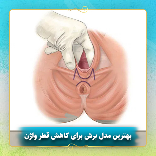 بهترین-مدل-برش-برای-کاهش-قطر-واژن