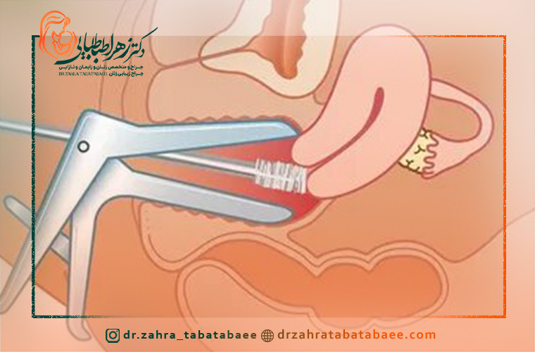 لکه بینی بعد از تست پاپ اسمیر