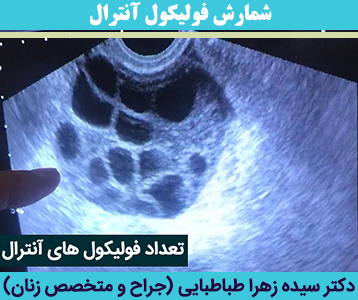 شمارش-فولیکول-آنترال