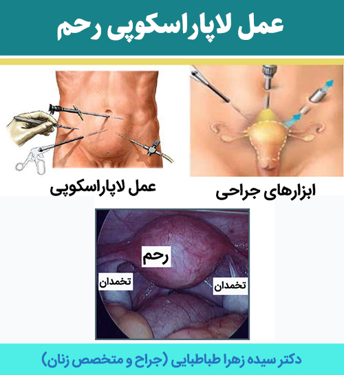 عمل-لاپاراسکوپی-رحم