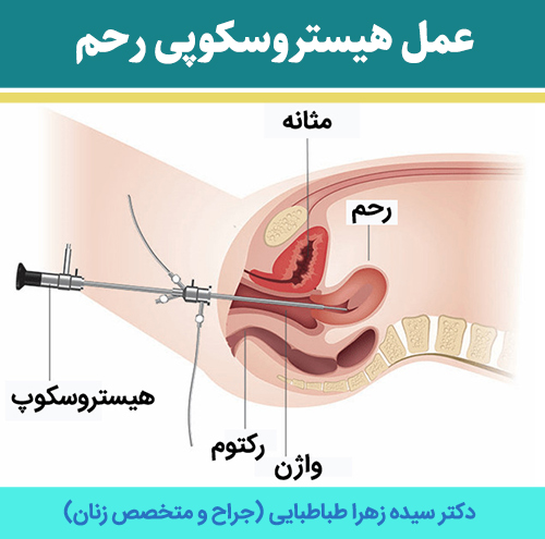 عمل-هیستروسکوپی-رحم