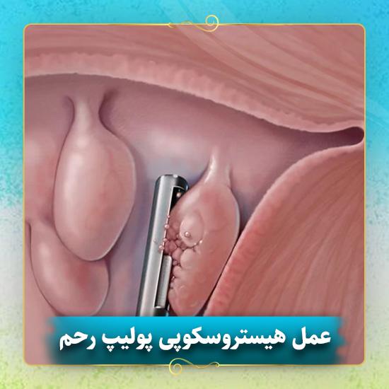 عمل-هیستروسکوپی-پولیپ-رحم