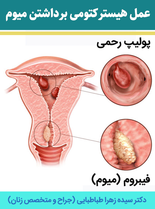 عمل-هیسترکتومی-برداشتن-میوم