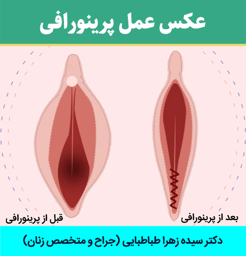 عکس-عمل-پرینورافی
