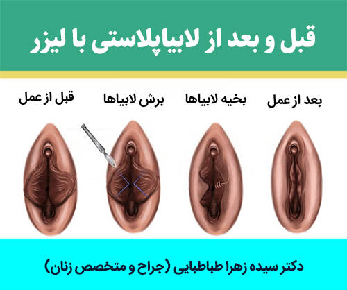 قبل-و-بعد-از-لابیاپلاستی-با-لیزر