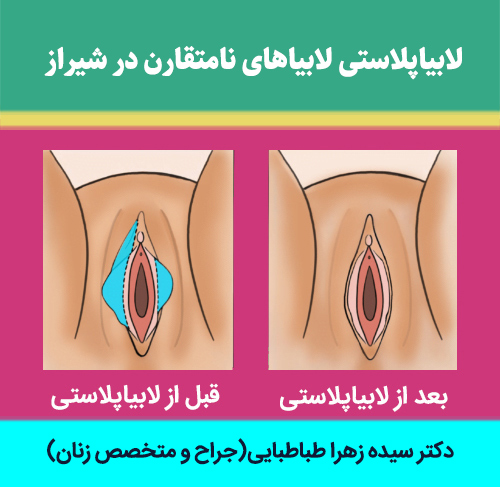 لابیاپلاستی-لابیاهای-نامتقارن-در-شیراز