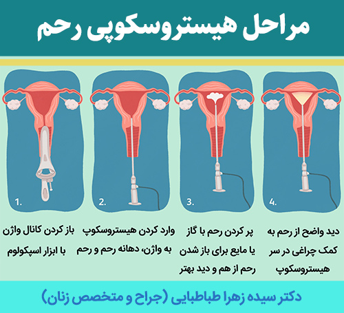 مراحل-هیستروسکوپی-رحم