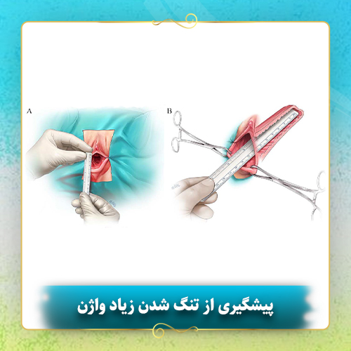 پیشگیری-از-تنگ-شدن-زیاد-واژن