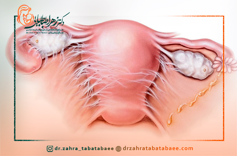 عمل میومکتومی و بارداری