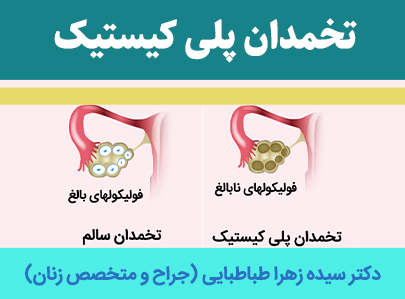تخمدان-پلی-کیستیک