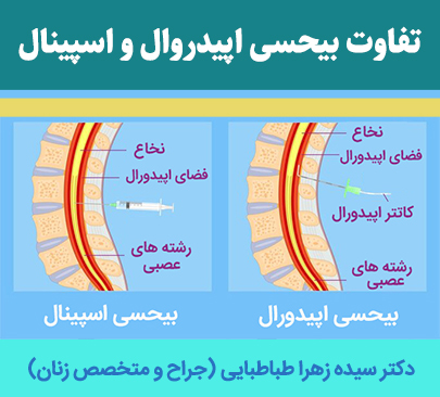 تفاوت-بیحسی-اپیدروال-و-اسپینال