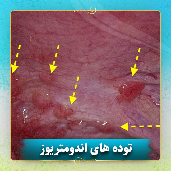 توده-های-اندومتریوز
