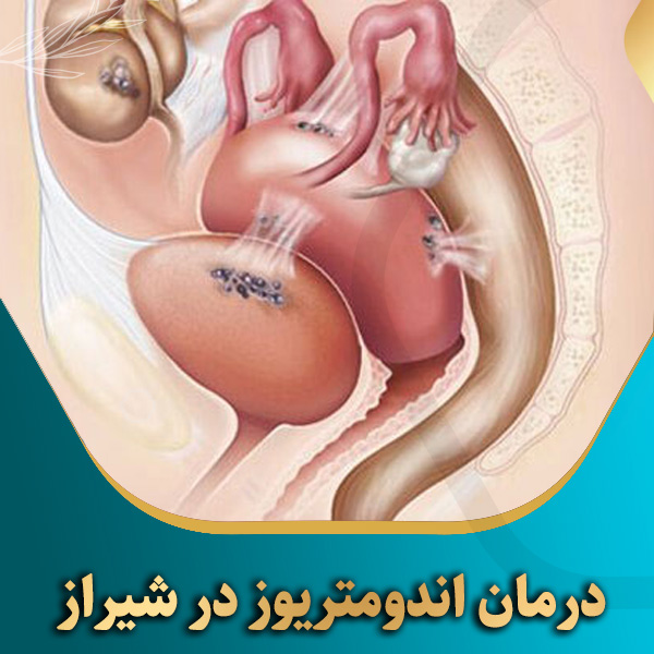 درمان-اندومتریوز-در-شیراز