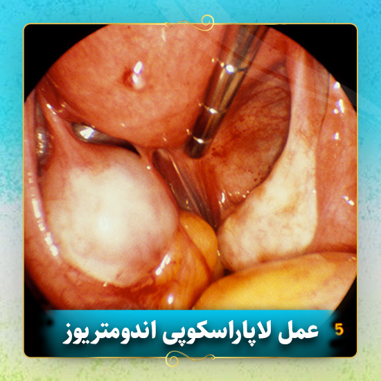 عمل-لاپاراسکوپی-اندومتریوز