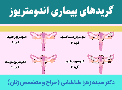 گریدهای-بیماری-اندومتریوز