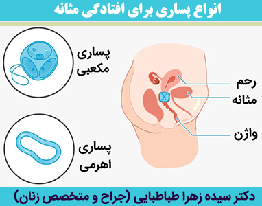 انواع-پساری-برای-افتادگی-مثانه