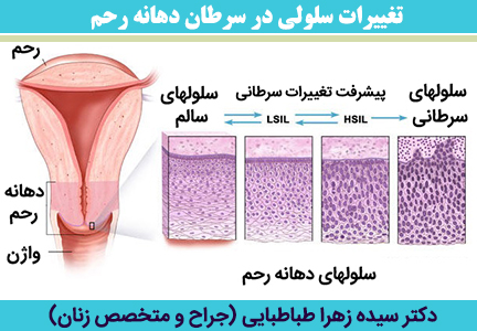 تغییرات-سلولی-در-سرطان-دهانه-رحم