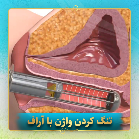 تنگ-کردن-واژن-با-آراف