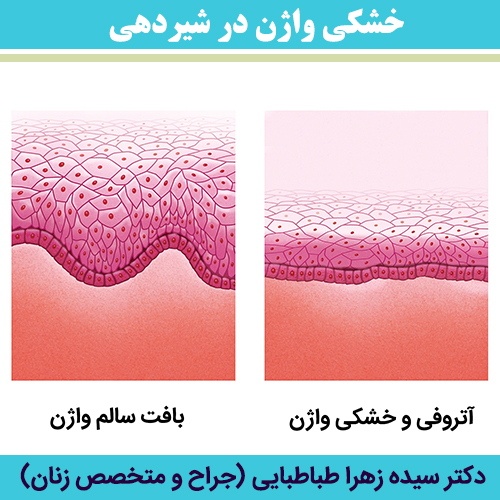 خشکی-واژن-در-شیردهی