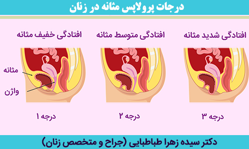 درجات-پرولاپس-مثانه-در-زنان