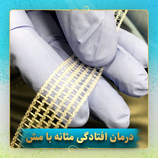 درمان-افتادگی-مثانه-با-مش