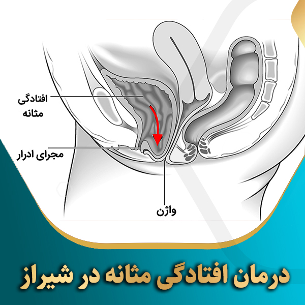 درمان-افتادگی-مثانه-در-شیراز