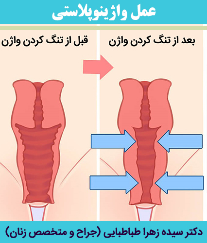 عمل-واژینوپلاستی