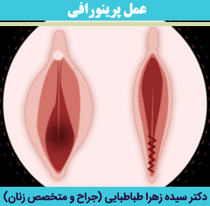 عمل-پرینورافی
