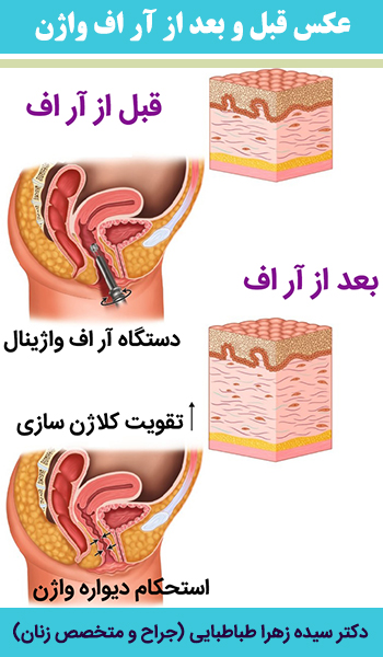 عکس-قبل-و-بعد-از-آر-اف-واژن