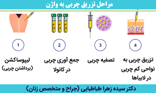 مراحل-تزریق-چربی-به-واژن
