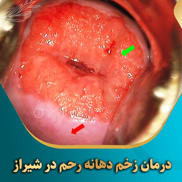 درمان-زخم-دهانه-رحم-در-شیراز